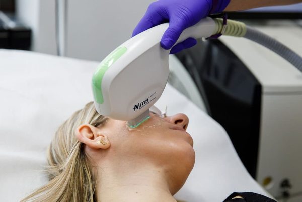 thumb laserul dye vl - skinmed clinic