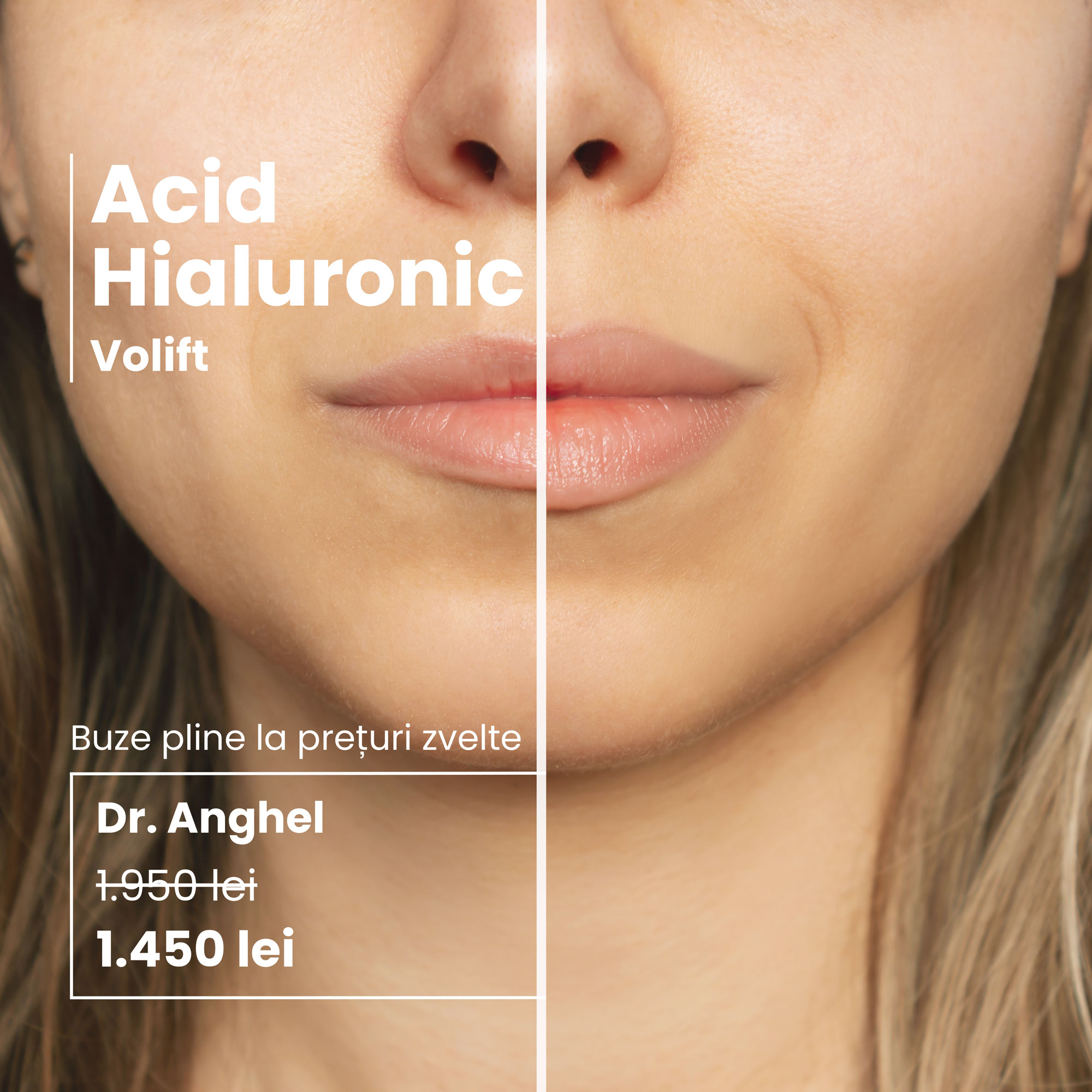 oferta ianuarie 25 acid hialuronic skinmed clinic